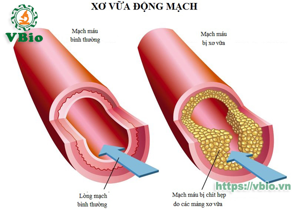 đông trùng hạ thảo chữa bệnh động mạch vành