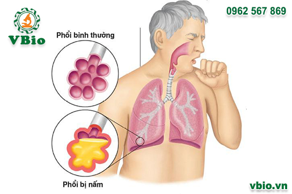 Bệnh nấm phổi